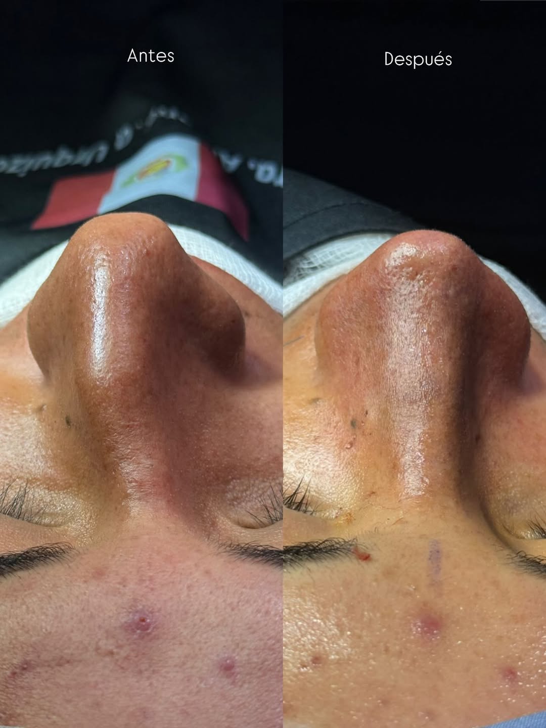 Caso 1 — resultado de rinoplastia