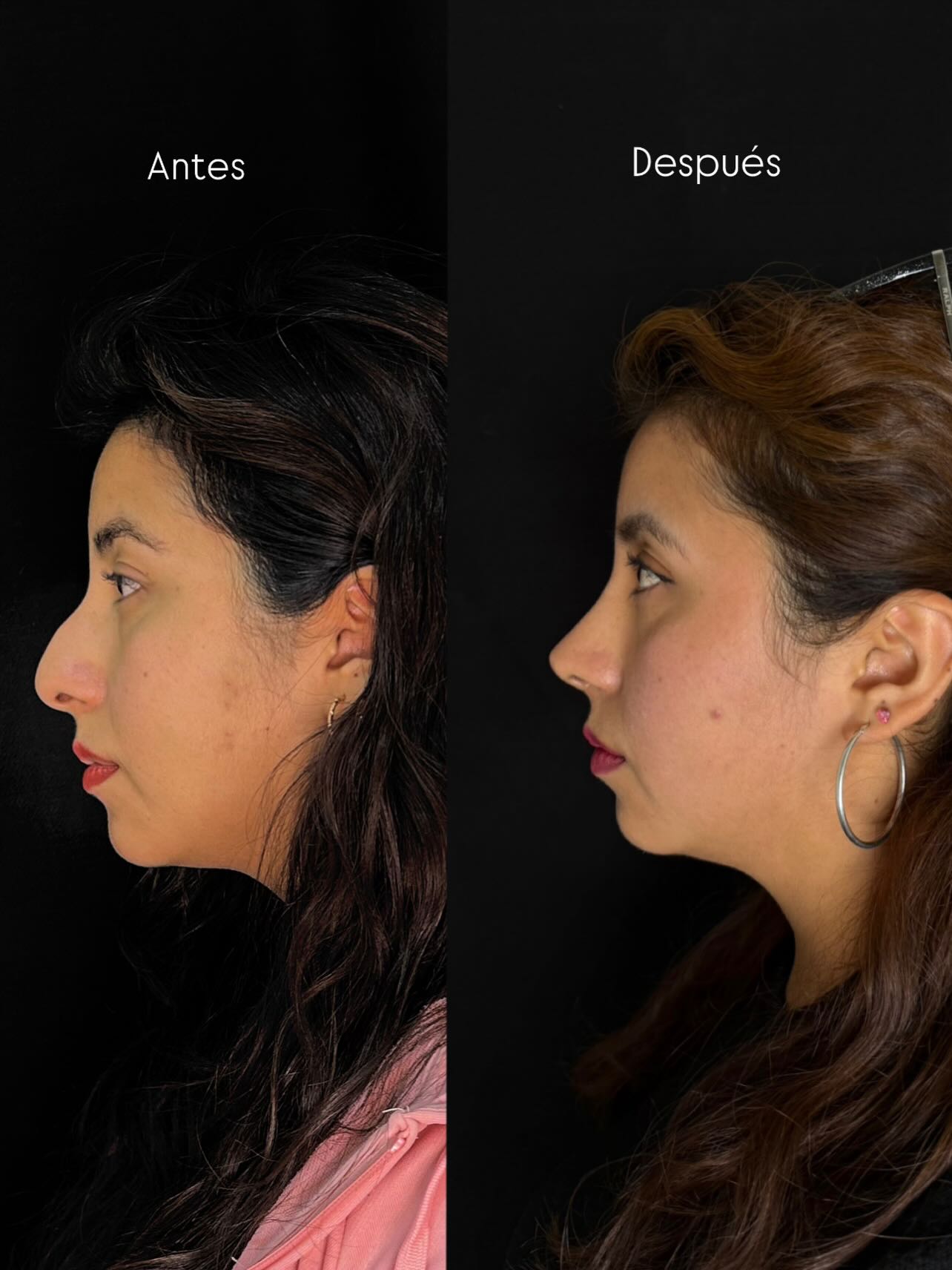 Caso 2 — resultado de rinoplastia