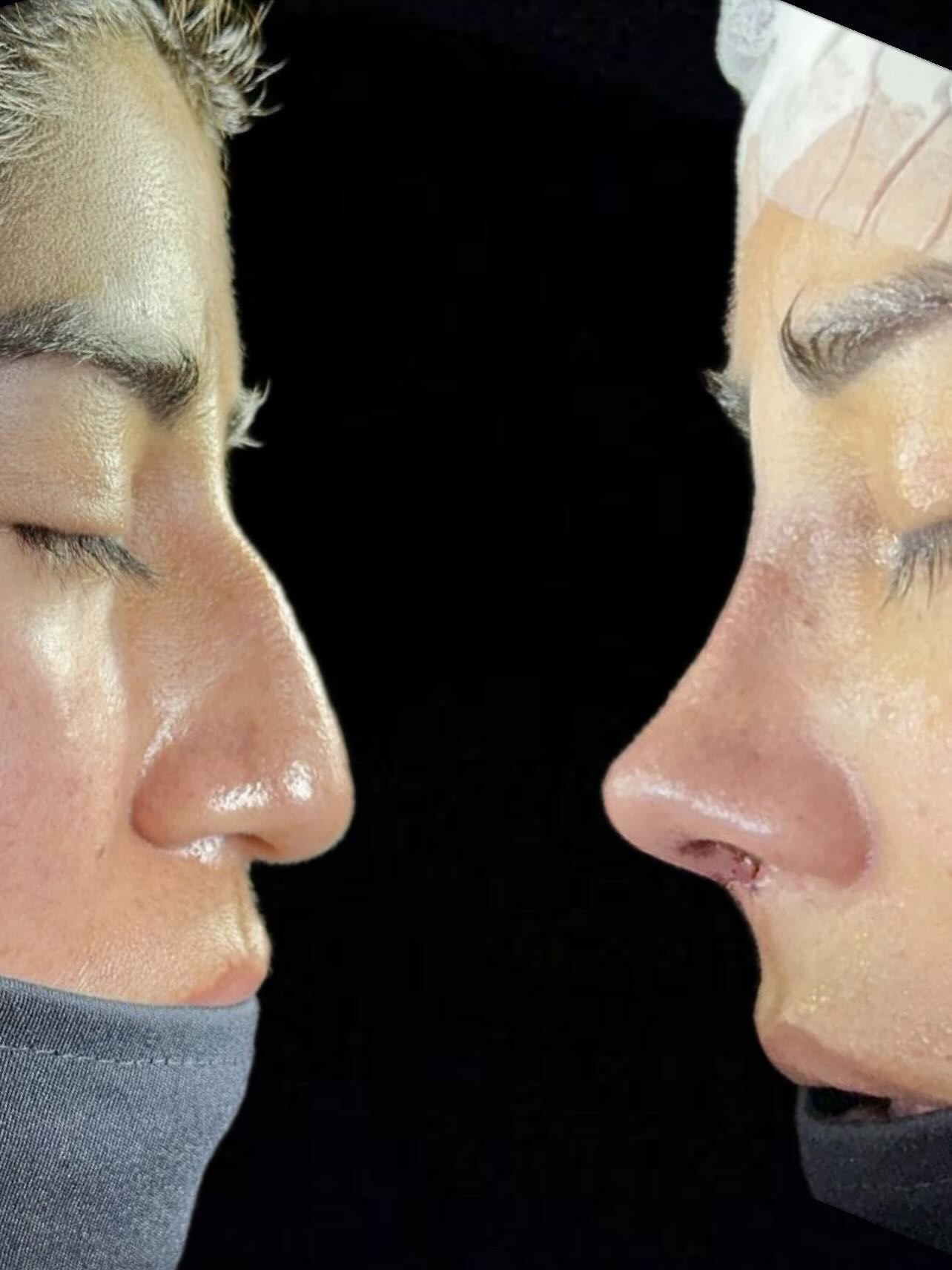 Caso 5 — resultado de rinoplastia