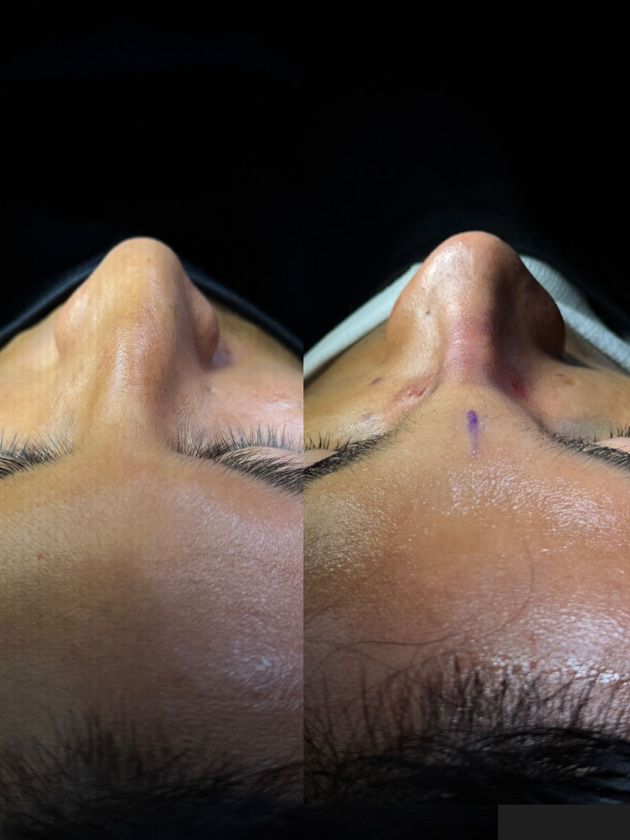 Caso 6 — resultado de rinoplastia
