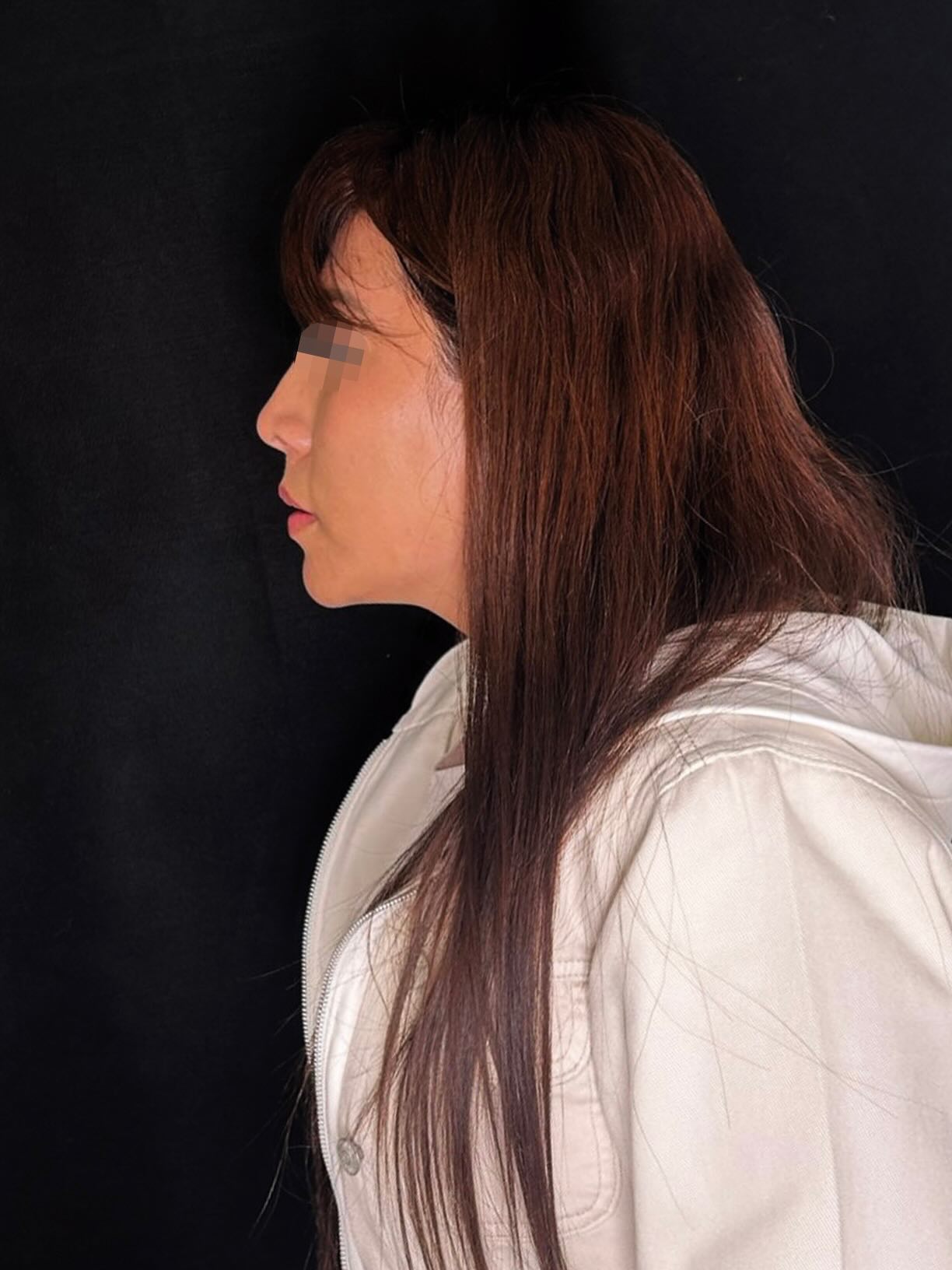 Caso 7 — resultado de rinoplastia